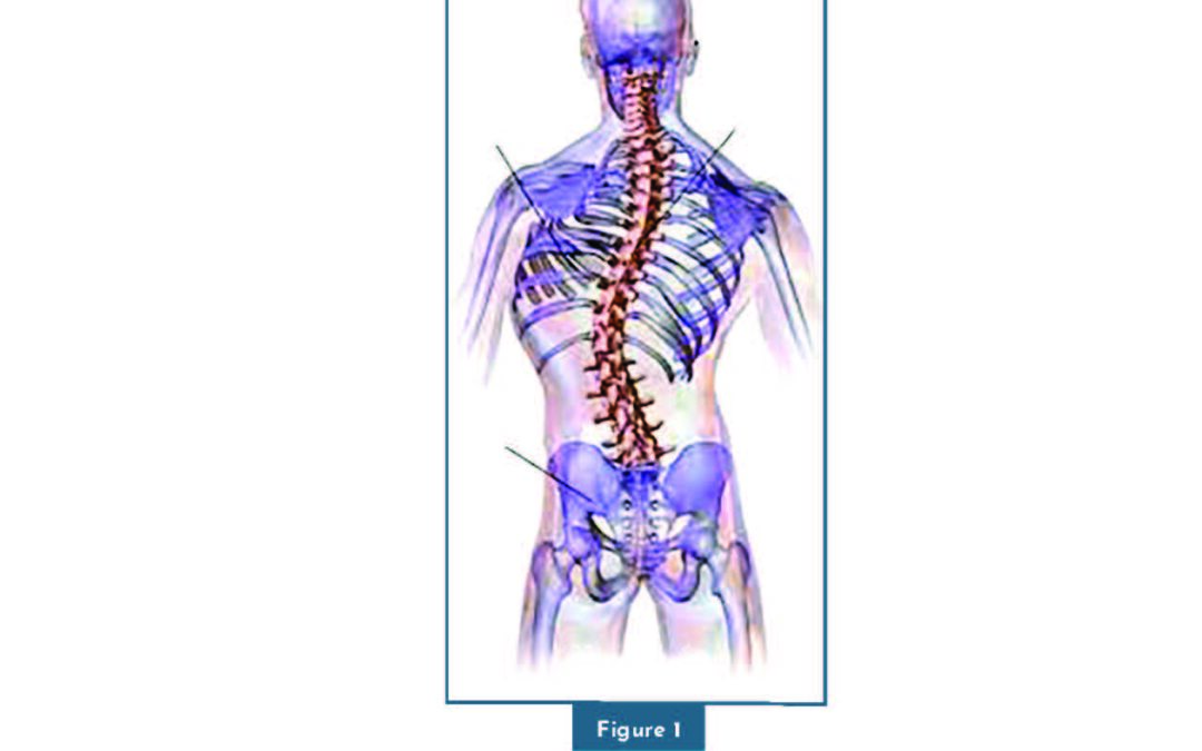 ‘How does a functional scoliosis develop and how does it lead to pain?’