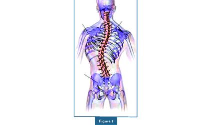‘How does a functional scoliosis develop and how does it lead to pain?’