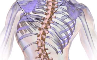 Functional Scoliosis FAQs (part 5 in 5 part series)