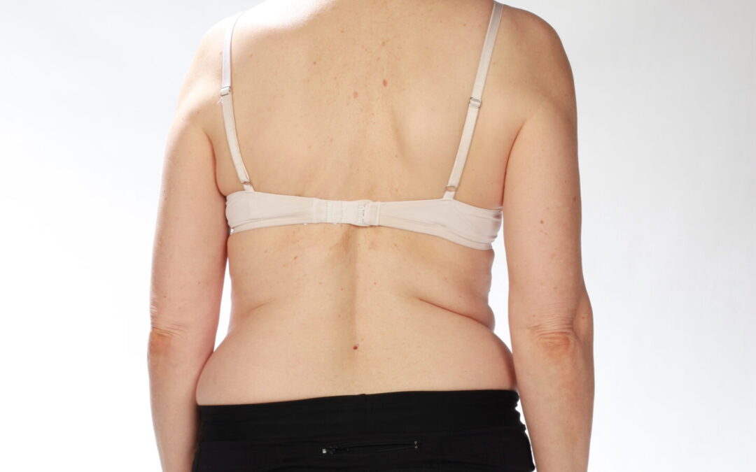 ‘Why is my back pain not improving or keeps coming back?’ You could have a functional scoliosis…